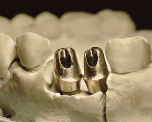 titanium abutment